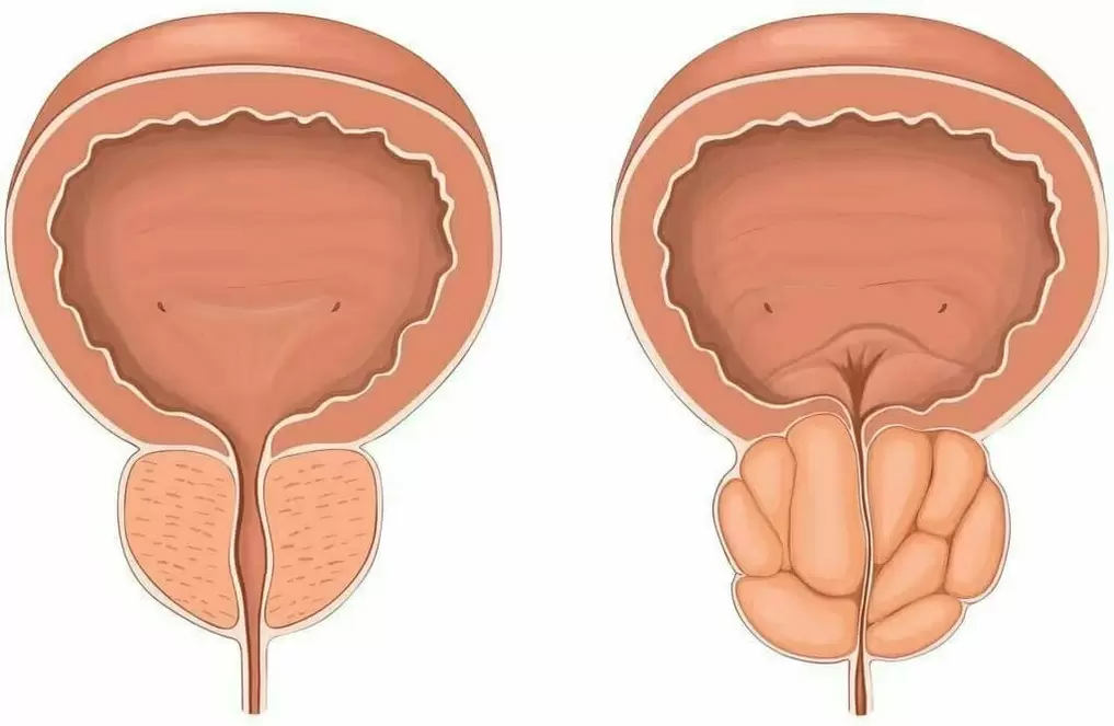Prostatitis und gesunde Prostata