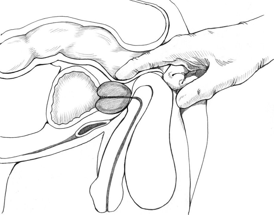 Die Prostatamassage gehört zum Komplex der Methoden zur Behandlung von Prostatitis.
