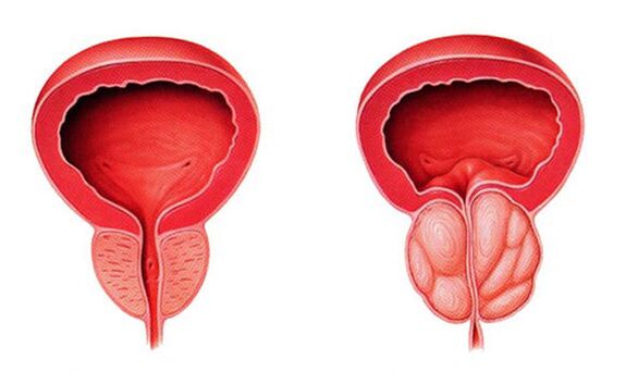 Normale und entzündete Prostata (Prostatitis)